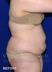 Liposuction - Abdomen & Flanks Patient 26351 Before Photo # 5