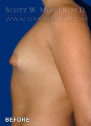Breast Augmentation Patient 83000 Before Photo Thumbnail # 3