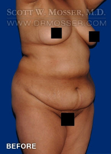 Liposuction - Abdomen & Flanks Patient 39968 Before Photo # 5
