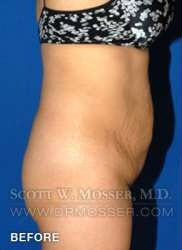 Liposuction - Abdomen & Flanks Patient 30590 Before Photo # 7