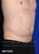 Liposuction - Abdomen & Flanks Patient 64992 Before Photo Thumbnail # 3
