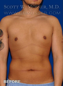 Liposuction - Chest Patient 38439 Before Photo # 1
