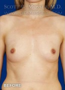 Breast Augmentation Patient 10196 Before Photo Thumbnail # 1