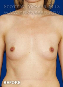 Breast Augmentation Patient 10196 Before Photo # 1