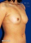 Breast Augmentation Patient 85660 Before Photo Thumbnail # 3