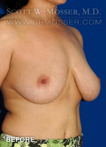 Breast Reduction Patient 13262 Before Photo # 3