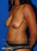 Breast Lift Without Implants Patient 55667 Before Photo Thumbnail # 5