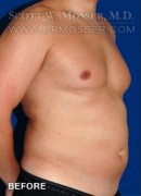Liposuction - Chest Patient 10587 Before Photo Thumbnail # 3