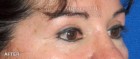 Upper Blepharoplasty Patient 79210 After Photo Thumbnail # 4