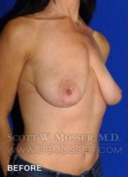Breast Lift With Implants Patient 19074 Before Photo # 3