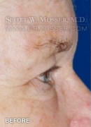 Upper Blepharoplasty Patient 93893 Before Photo Thumbnail # 5