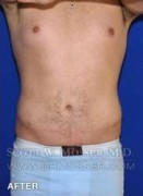 Liposuction - Abdomen & Flanks Patient 25141 After Photo Thumbnail # 2