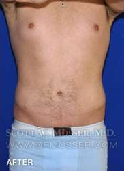 Liposuction - Abdomen & Flanks Patient 25141 After Photo # 2