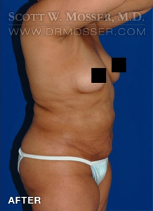 Liposuction - Abdomen & Flanks Patient 39968 After Photo # 4