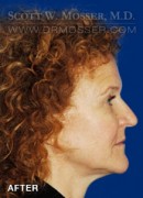 Upper Blepharoplasty Patient 45312 After Photo Thumbnail # 6