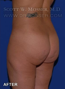 Brazilian Butt Lift Patient 32708 After Photo # 6