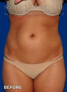 Liposuction - Abdomen & Flanks Patient 83778 Before Photo # 1