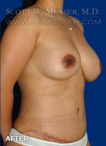 Breast Augmentation Patient 27533 After Photo # 6