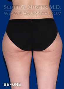 Liposuction - Thighs Patient 97167 Before Photo # 3