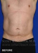 Liposuction - Abdomen & Flanks Patient 64992 Before Photo Thumbnail # 1
