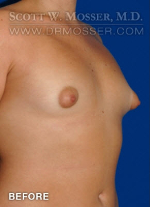 Breast Augmentation Patient 83000 Before Photo # 5