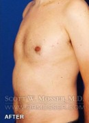 Liposuction - Chest Patient 34240 After Photo Thumbnail # 6