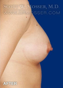 Breast Augmentation Patient 84593 After Photo # 6