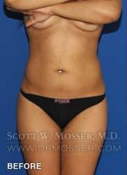 Liposuction - Abdomen & Flanks Patient 33709 Before Photo # 1