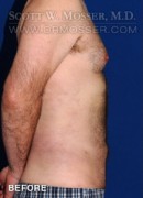 Liposuction - Abdomen & Flanks Patient 23232 Before Photo Thumbnail # 11