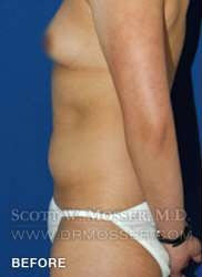Liposuction - Abdomen & Flanks Patient 58519 Before Photo # 9