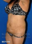 Liposuction - Abdomen & Flanks Patient 30590 Before Photo Thumbnail # 5