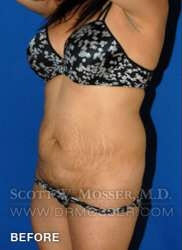 Liposuction - Abdomen & Flanks Patient 30590 Before Photo # 5