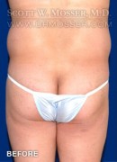 Liposuction - Abdomen & Flanks Patient 68884 Before Photo Thumbnail # 7