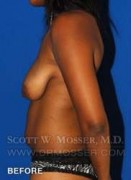 Breast Lift Without Implants Patient 55667 Before Photo Thumbnail # 9