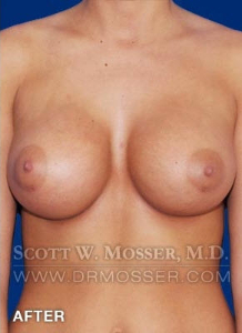 Breast Augmentation Patient 87318 After Photo # 2