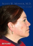 Upper Blepharoplasty Patient 92612 Before Photo Thumbnail # 5