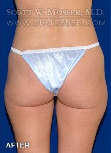 Liposuction - Thighs Patient 10722 After Photo # 2