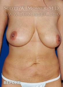 Mommy Makeover Patient 60933 Before Photo # 1