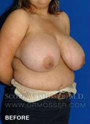 Breast Reduction Patient 27332 Before Photo # 1