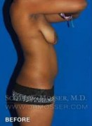 Liposuction - Abdomen & Flanks Patient 11942 Before Photo Thumbnail # 7