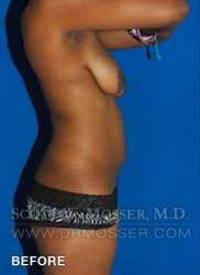 Liposuction - Abdomen & Flanks Patient 11942 Before Photo # 7