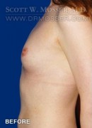 Breast Augmentation Patient 88566 Before Photo Thumbnail # 3