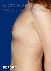 Breast Augmentation Patient 88566 Before Photo # 3