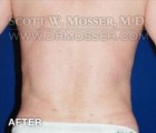 Liposuction - Abdomen & Flanks Patient 62116 After Photo Thumbnail # 4