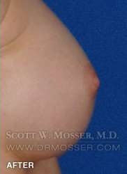 Nipple Inversion Correction Patient 70533 After Photo # 6