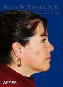 Upper Blepharoplasty Patient 92612 After Photo Thumbnail # 6