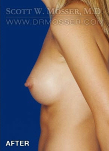 Breast Augmentation Patient 10196 After Photo # 6
