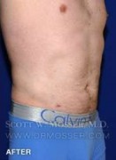 Liposuction - Abdomen & Flanks Patient 64992 After Photo Thumbnail # 4