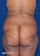 Lower Body Lift Patient 16603 Before Photo Thumbnail # 7