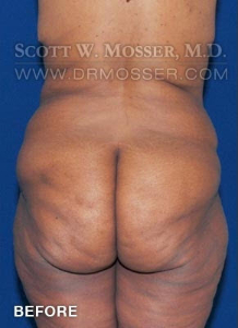 Lower Body Lift Patient 16603 Before Photo # 7
